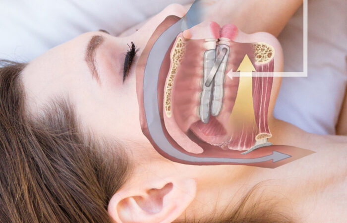 Sleep Apnea Appliance Dental: Effective Non-Invasive Treatment Option